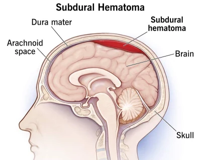 Ilustración que muestra un hematoma subdural entre el cerebro y su cubierta protectora externa, la duramadre.